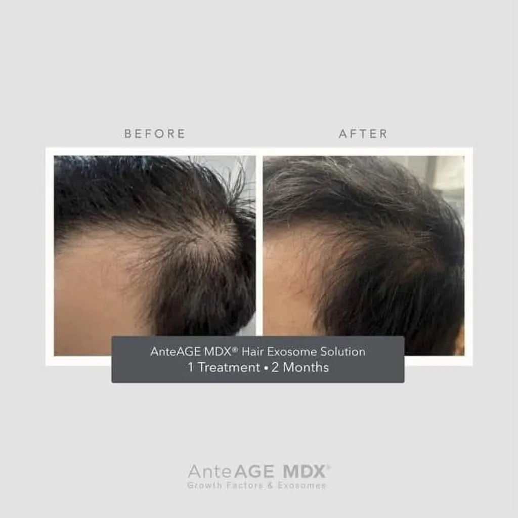 AnteAGE MD Hair Restoration