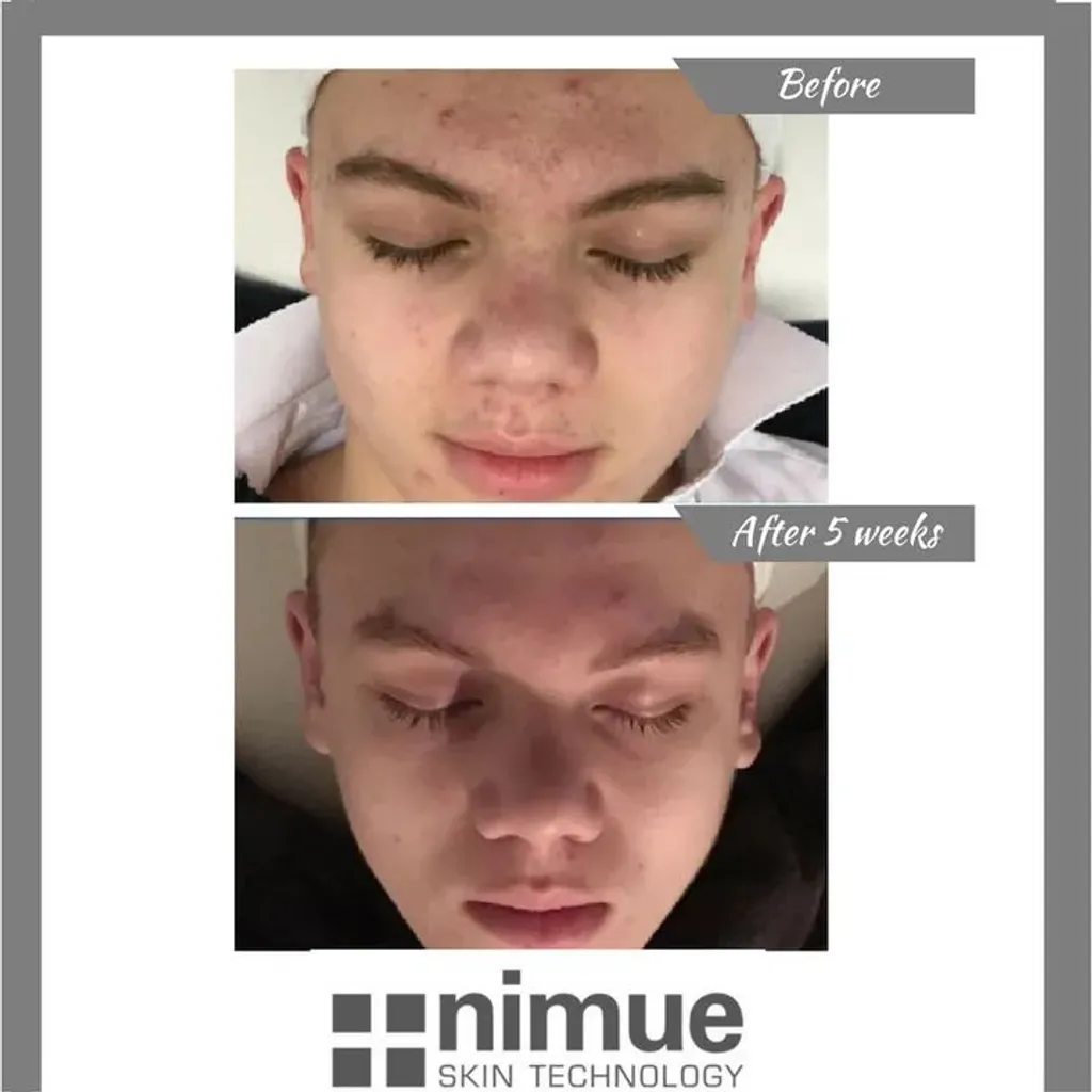 Teenage Facial £55 with Hydra £65