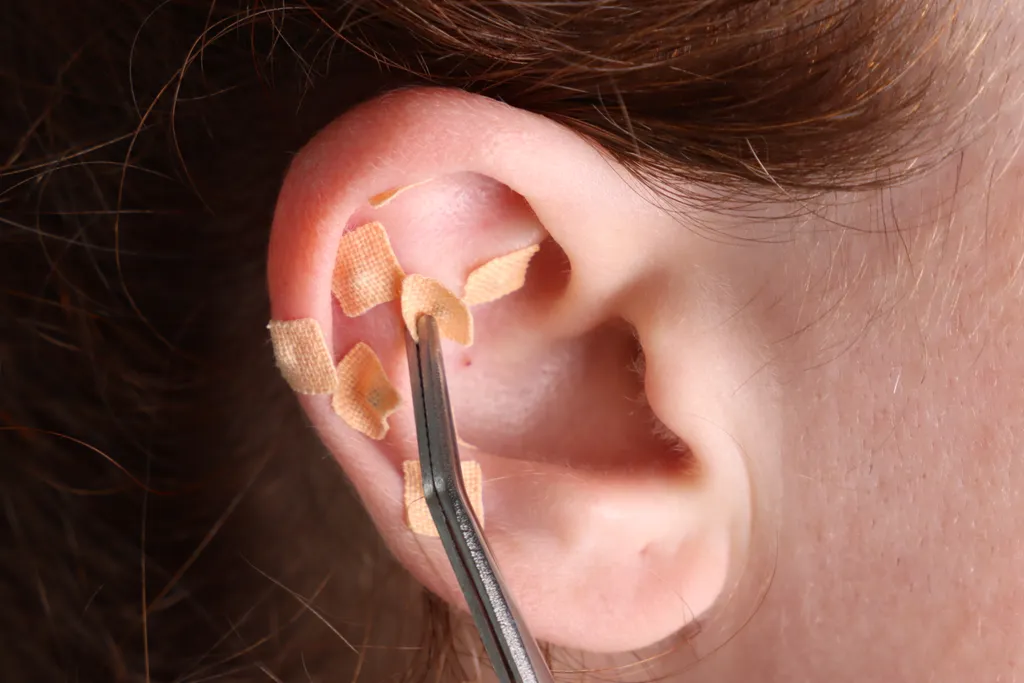 Ear Seeding Acupuncture